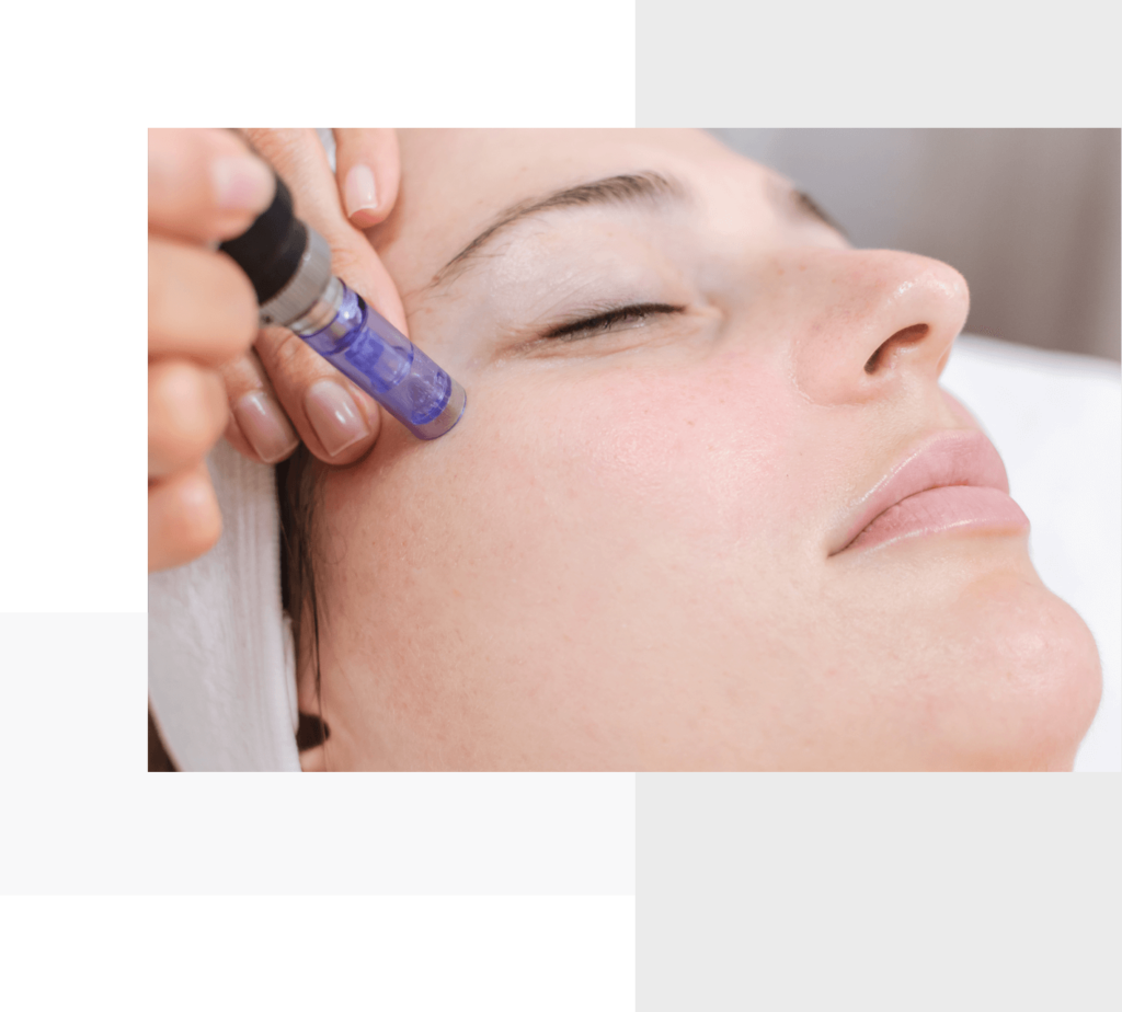 bodybar clinical microneedling (1)