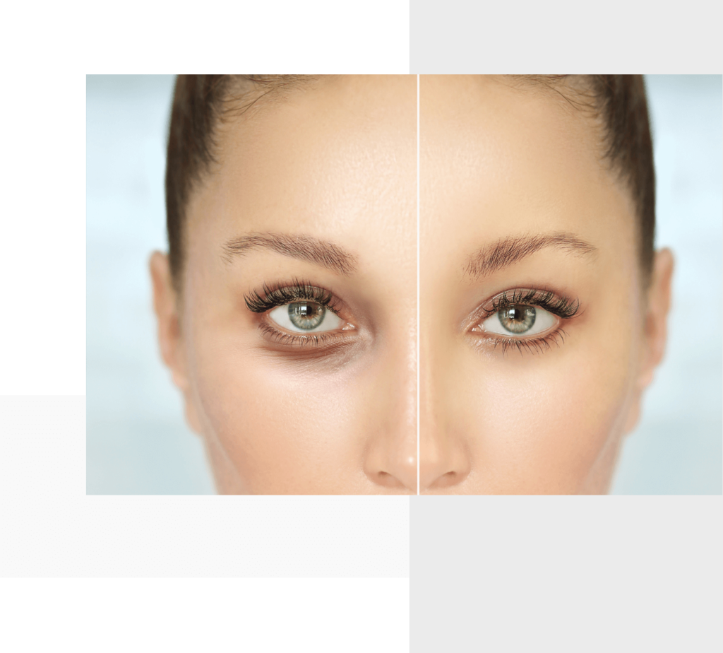 Woman's eyes before and after a treatment.