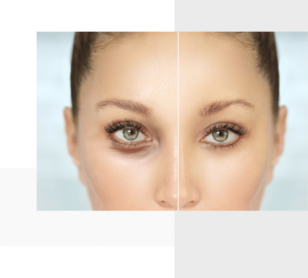 bodybar wellness tear trough (1) Woman's eyes before and after a treatment.